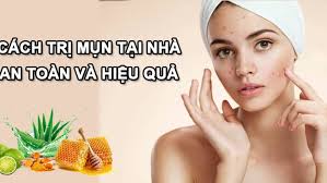 Desloratadine 5mg Trị Mụn