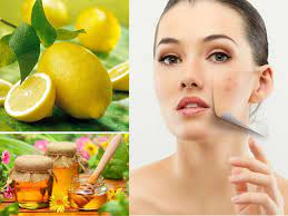 Desloratadine 5mg Trị Mụn