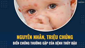 Thủy Đậu Nổi Trong Miệng